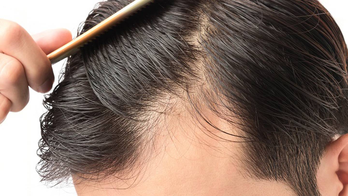 Finasteride vs. Minoxidil: Which men's hair loss treatment is best? –  Action News Jax