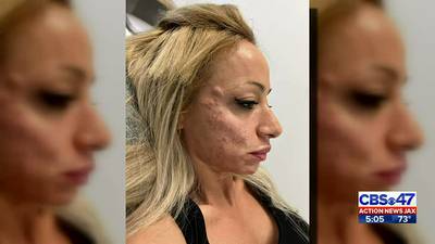 ‘Botox bandit:’ Woman returns to pay nearly $2,600 botox bill at Jacksonville Beach med spa