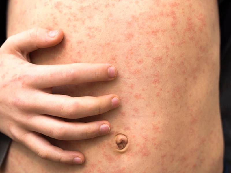 Measles causes a red rash, high fever and other symptoms.