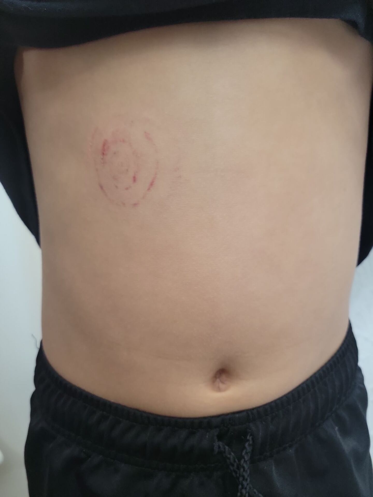 A 9-year-old Clay County boy is recovering after falling off of his bicycle, causing him to have a grade 4 laceration of his pancreas.